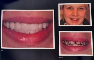 Full transformation: before treatment, the patient suffered from extensive decay, significant wear, and severely compromised tooth structure; after treatment, a full mouth rehabilitation utilizing custom porcelain restorations completely restored functional integrity and natural-looking aesthetics.